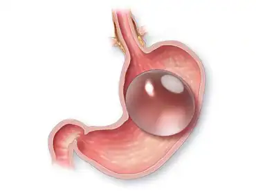 Balon gastrico allurion